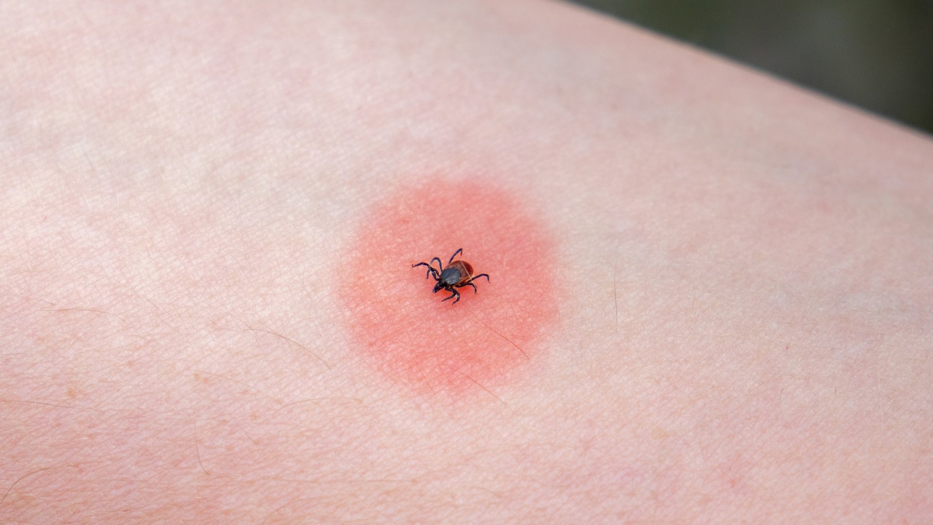 Die sogenannte Wanderröte ist ein typisches Anzeichen einer Borreliose.